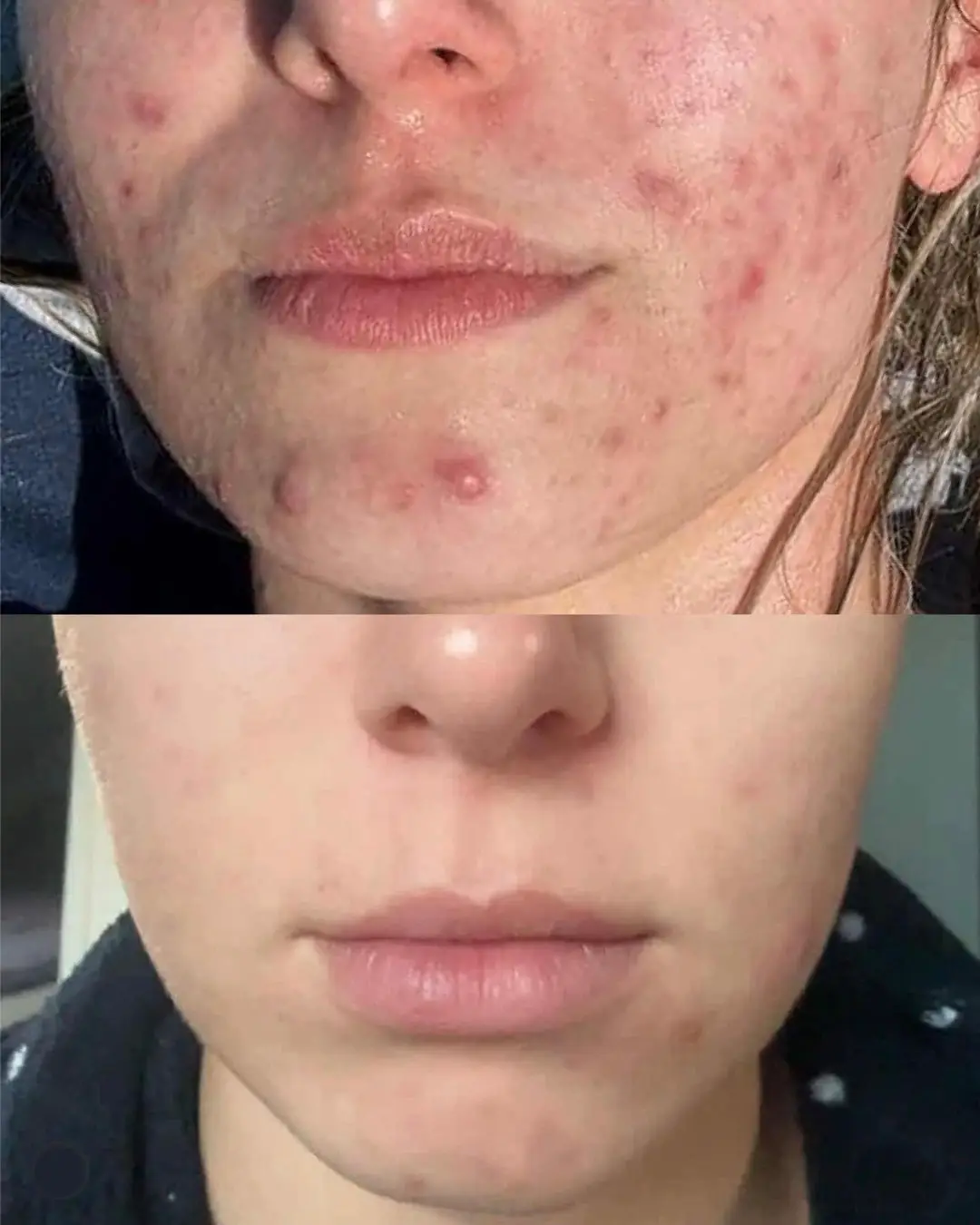 Severe acne and scars — 8 weeks of protocol