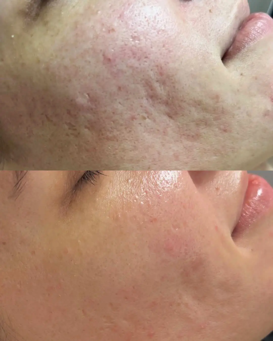 Acne scars and texture — 6 weeks of protocol
